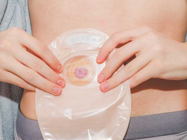 Stoma